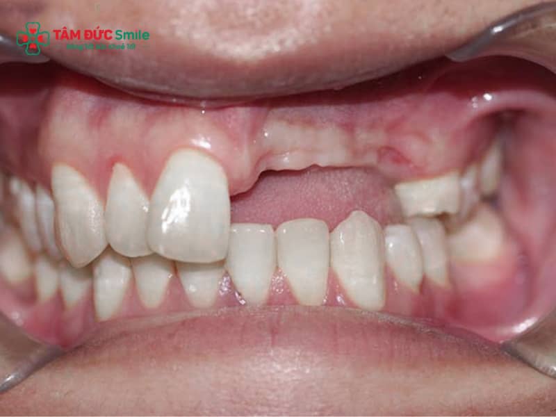 Mất nhiều răng liền kề: Trồng Implant hay cầu răng sứ tốt?