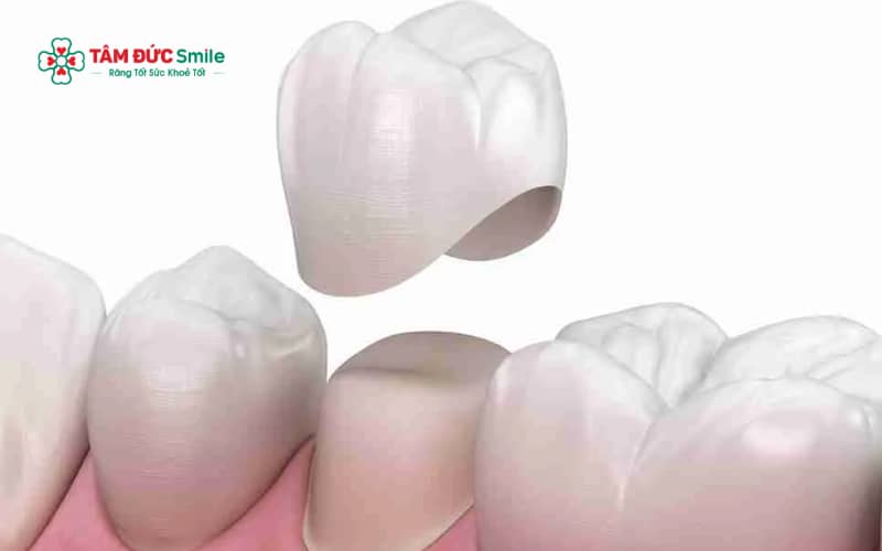 Bọc răng sứ thường được chỉ định khi răng xỉn màu nặng, nhiễm màu kháng sinh hoặc có khuyết điểm về hình dạng