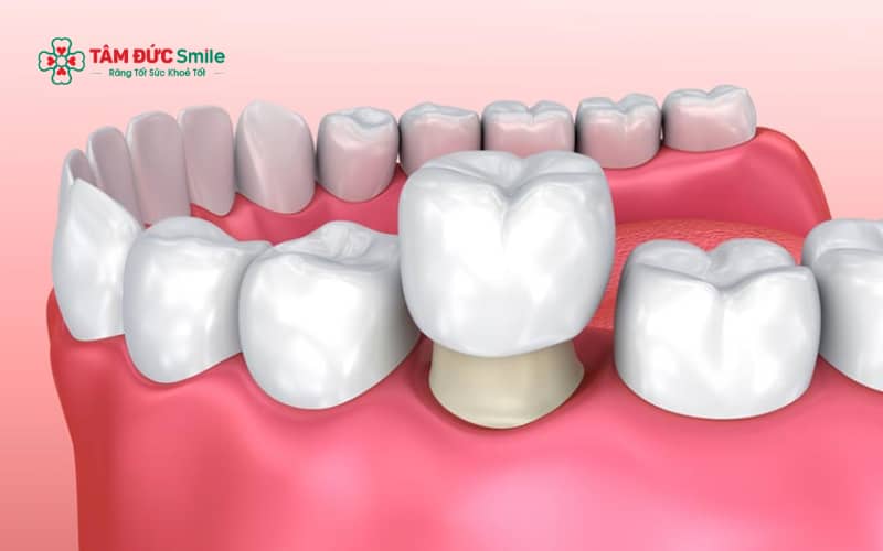 Tẩy trắng răng và bọc răng sứ là hai phương pháp cải thiện màu sắc răng phổ biến với ưu điểm và chi phí khác nhau