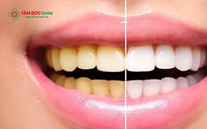 Răng ố vàng, xỉn màu có thể cải thiện bằng các phương pháp thẩm mỹ nha khoa như tẩy trắng răng hoặc bọc răng sứ.