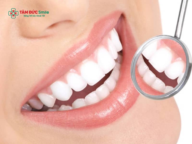 Nên tẩy trắng răng hay bọc sứ? So sánh chi phí, độ bền, thẩm mỹ
