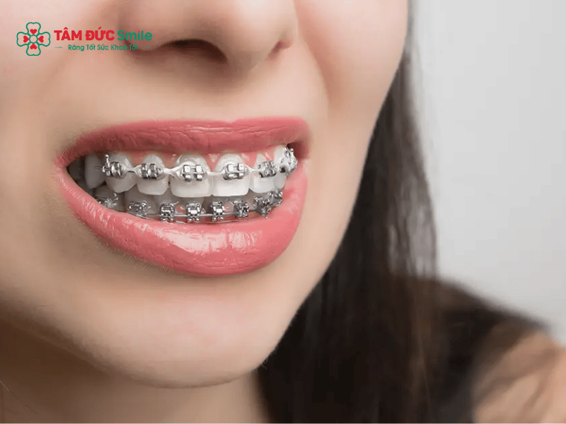 Nhổ răng để niềng có nguy hiểm? Nhổ răng số 4, hô, chen chúc