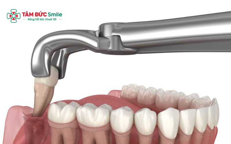 Nhổ răng khôn bị nổi hạch là tình trạng khá nhiều người gặp phải sau khi thực hiện tiểu phẫu răng số 8