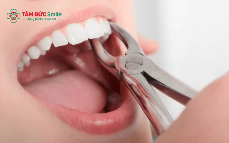 Tổn thương mô mềm, phản ứng viêm tự nhiên hoặc nhiễm trùng là những nguyên nhân phổ biến gây sưng mặt sau khi nhổ răng khôn
