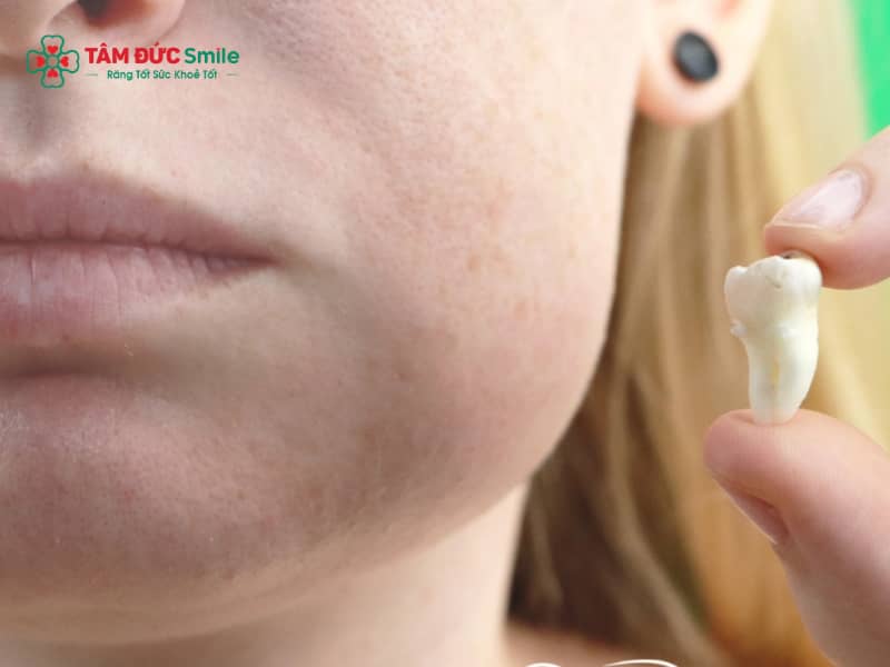 Nhổ răng khôn bị sưng má: Nguyên nhân, cách giảm sưng an toàn