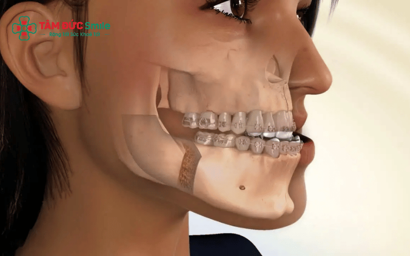 Niềng răng có thể cải thiện hiệu quả tình trạng móm do răng, giúp khớp cắn cân đối và thẩm mỹ khuôn mặt tốt hơn