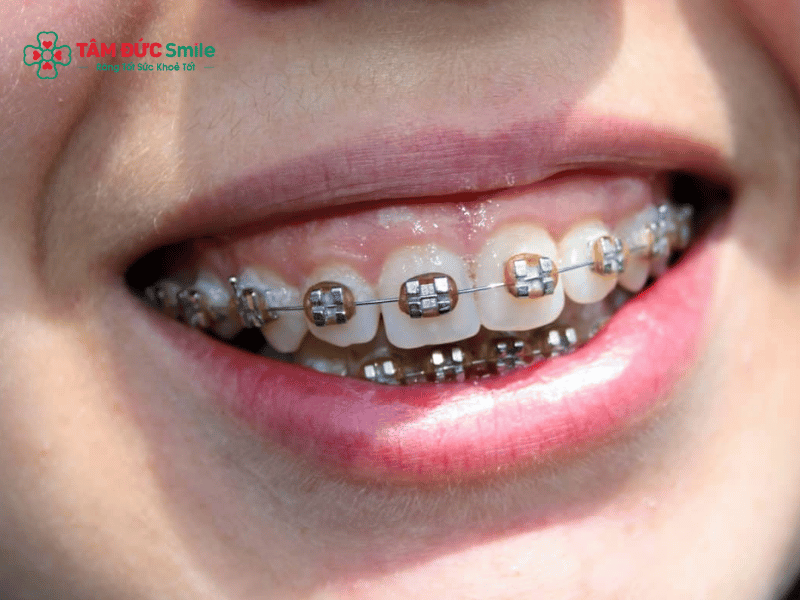 Niềng răng có hết móm không? Giải đáp móm do răng, xương hàm