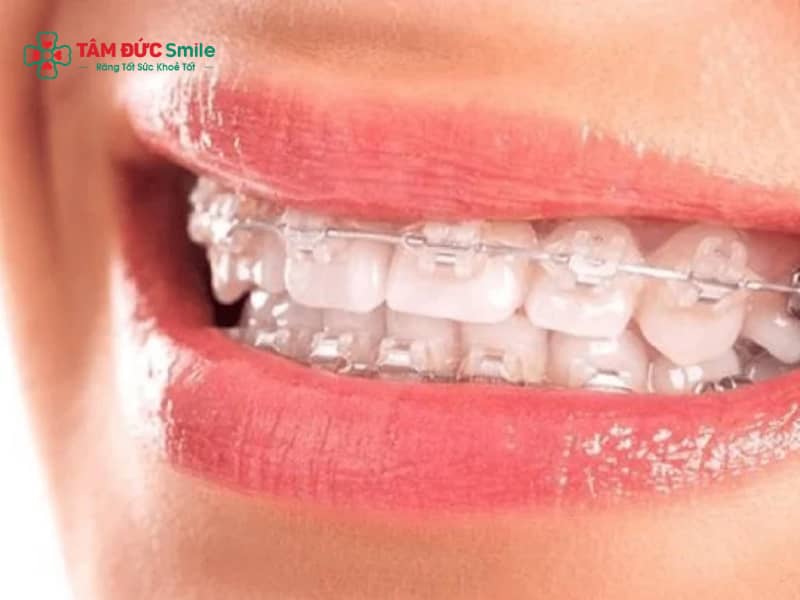 Niềng răng mắc cài sứ dây trong thẩm mỹ, ít lộ, hiệu quả cao
