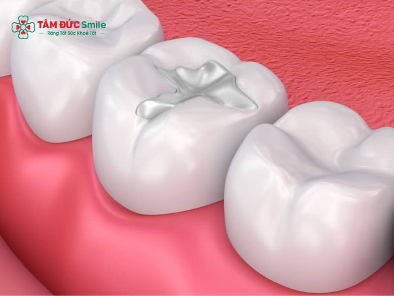 Quy trình trám răng chuẩn y khoa – Trám răng sâu, composite bền đẹp