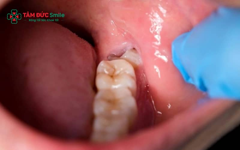 Răng khôn mọc kẹt có nguy cơ gây đau và biến chứng, thường được bác sĩ khuyến nghị nhổ sớm để tránh ảnh hưởng răng bên cạnh