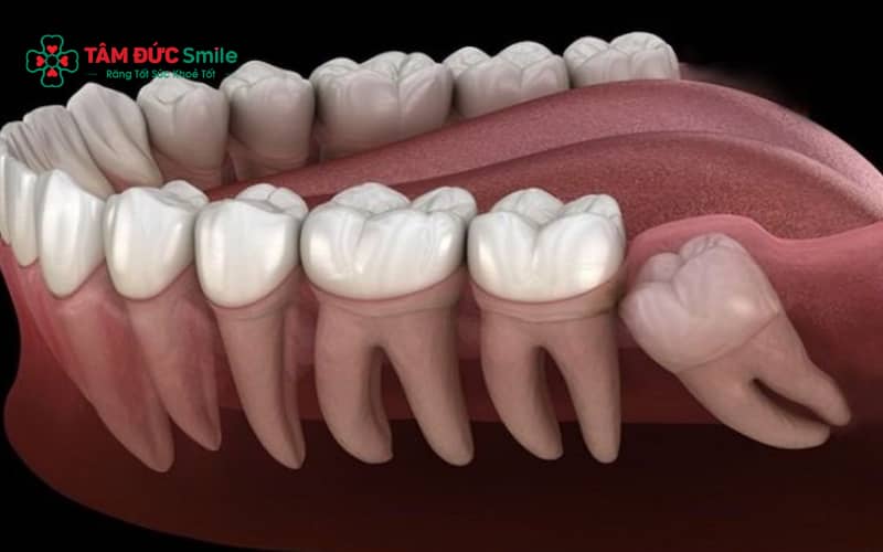 Răng khôn mọc kẹt có thể gây sâu răng số 7, áp xe, viêm xương hàm và ảnh hưởng khớp cắn nếu không điều trị kịp thời.
