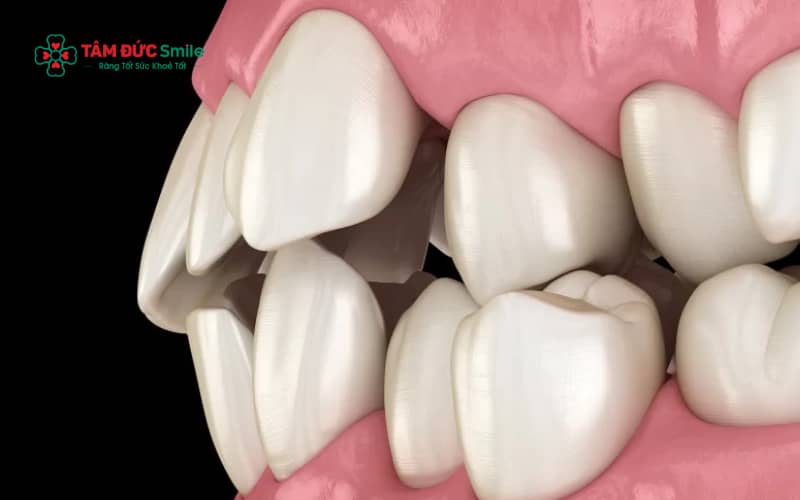 Răng lệch lạc, khấp khểnh là tình trạng phổ biến khiến nhiều người phân vân nên niềng răng hay bọc răng sứ