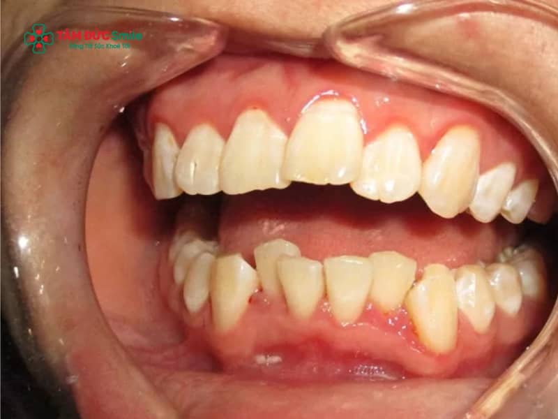 Răng lệch lạc nên niềng hay bọc sứ? So sánh chỉnh nha và sứ