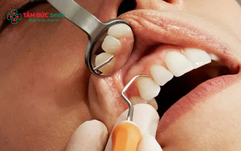 Răng bị lung lay cần được thăm khám kỹ lưỡng để xác định có thể bọc răng sứ hay cần điều trị trước