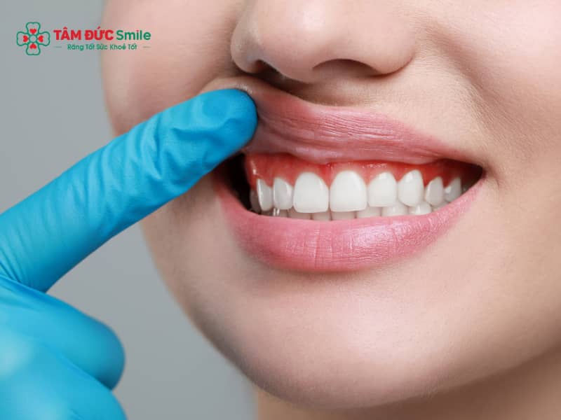 Răng nhạy cảm: Nguyên nhân ê buốt răng, tụt nướu và cách điều trị hiệu quả