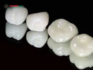 Răng sứ Alumina: Ưu điểm, giá bao nhiêu, so sánh Zirconia