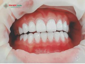 Răng sứ bị ê khi uống lạnh: Nguyên nhân, cách xử lý an toàn