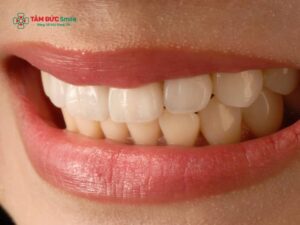 Răng sứ có ăn được đồ cứng không? Độ bền và khả năng chịu lực