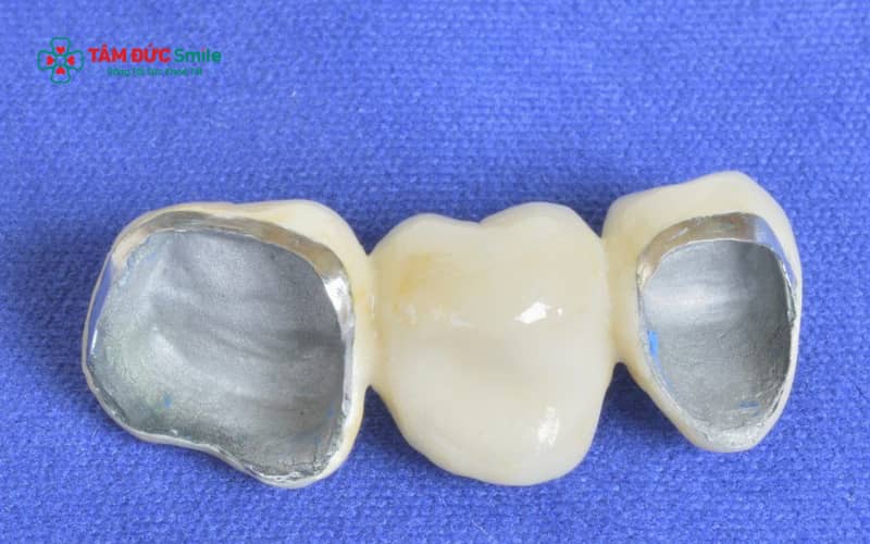 Răng sứ kim loại Mỹ có cấu tạo gồm lõi kim loại chắc chắn bên trong và lớp sứ phủ bên ngoài giúp cải thiện thẩm mỹ