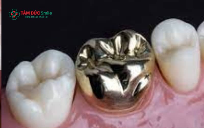 Răng sứ kim loại Mỹ có ưu điểm về chi phí và độ bền nhưng thẩm mỹ có thể không bằng răng toàn sứ.