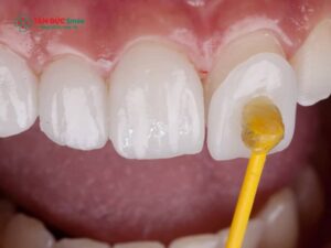 Răng sứ kim loại Mỹ có tốt không? Ưu nhược điểm?