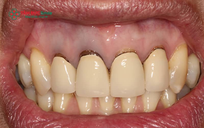 Răng sứ trắng đục thường xảy ra khi chọn sai vật liệu hoặc tông màu, khiến răng thiếu độ trong và mất tự nhiên.