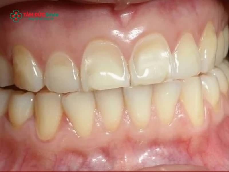 Răng sứ trắng đục: Nguyên nhân, khắc phục bằng răng toàn sứ