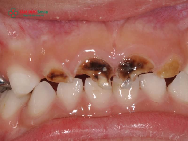 Sâu răng sữa ở trẻ em: Dấu hiệu, nguyên nhân, điều trị và phòng ngừa sớm