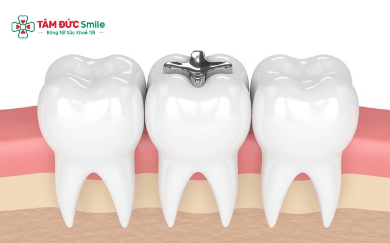 Miếng trám amalgam có màu bạc đặc trưng, thường được sử dụng để phục hồi răng sâu ở răng hàm