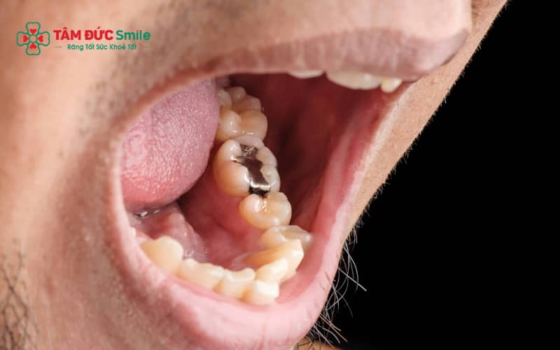 Trám răng amalgam thường được chỉ định cho răng hàm có lỗ sâu lớn và cần phục hồi khả năng chịu lực nhai