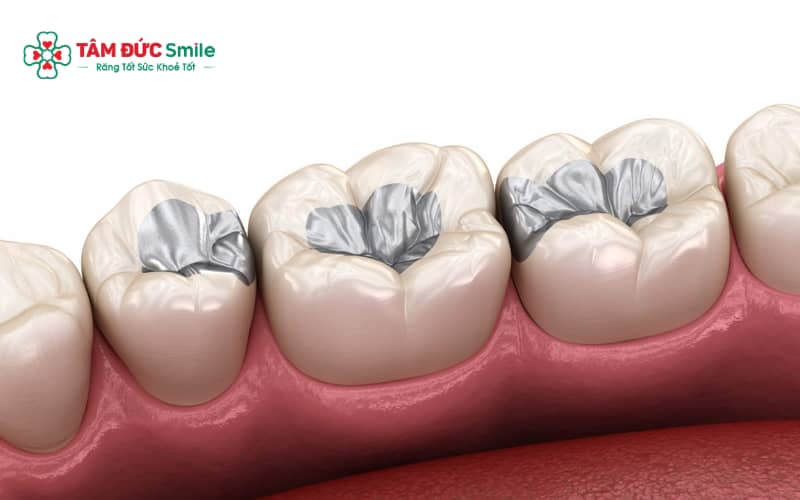 Miếng trám amalgam có độ bền và khả năng chịu lực nhai cao, phù hợp với răng hàm