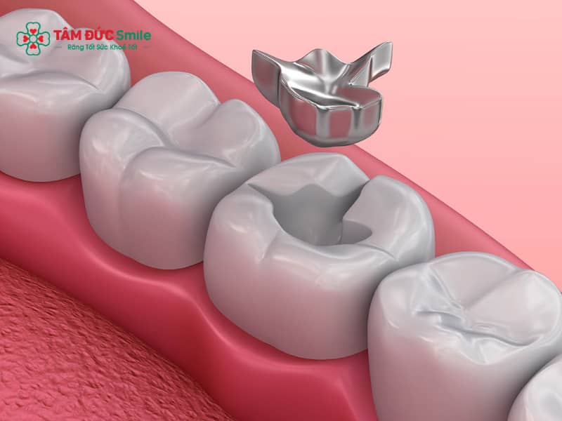 Trám răng amalgam – Hàn răng bạc chịu lực cao