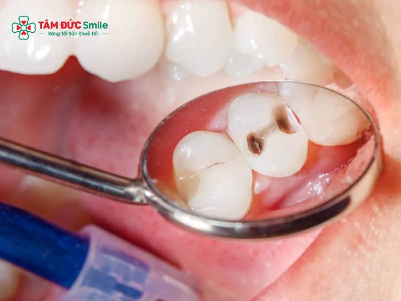 Trám răng mẻ có đau không?