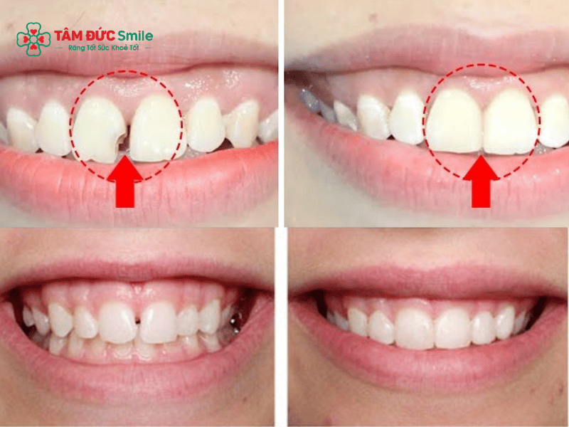 Hiệu quả trước và sau khi trám răng thưa giúp cải thiện thẩm mỹ và khép kín khe hở răng