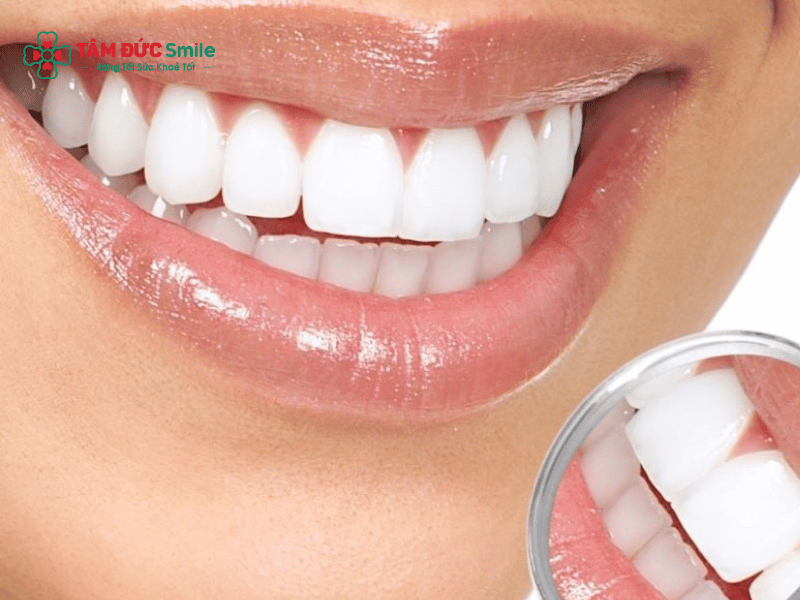 Trám răng thưa thẩm mỹ: hàn răng composite, nhanh, bền đẹp