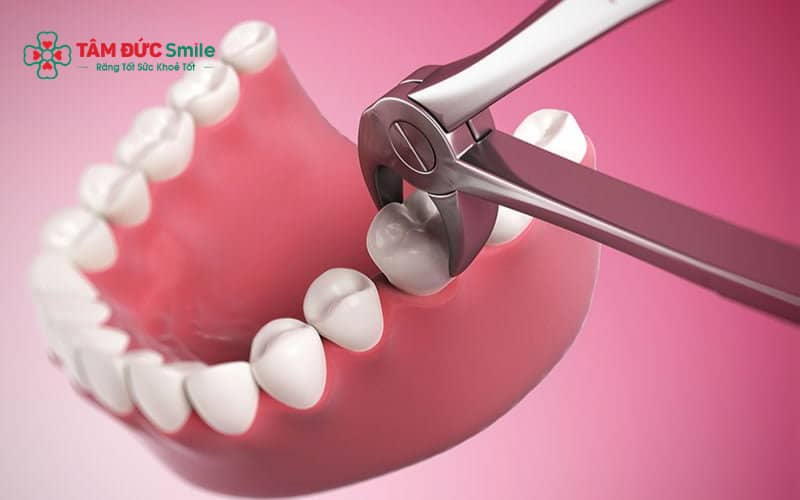 Trước khi nhổ răng khôn bằng gây tê, bệnh nhân nên ăn nhẹ để tránh mệt và đảm bảo sức khỏe trong quá trình thực hiện