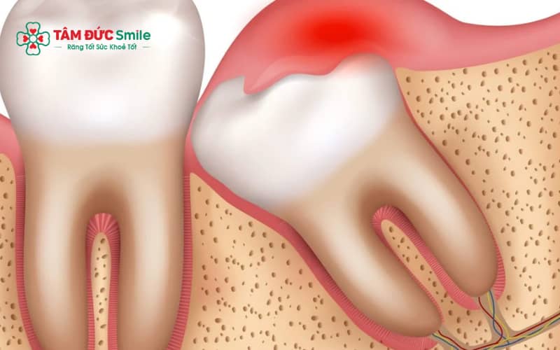 Trong trường hợp gây tê, bệnh nhân vẫn có thể ăn trước khi nhổ răng khôn để duy trì thể trạng ổn định