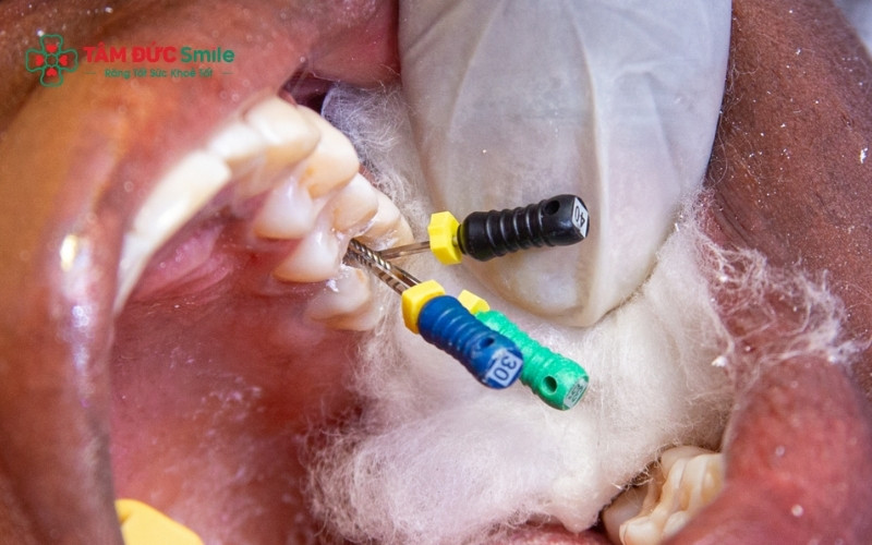 Răng sau khi lấy tủy trở nên giòn và dễ tổn thương hơn, vì vậy cần được chăm sóc đúng cách để duy trì độ bền lâu dài.