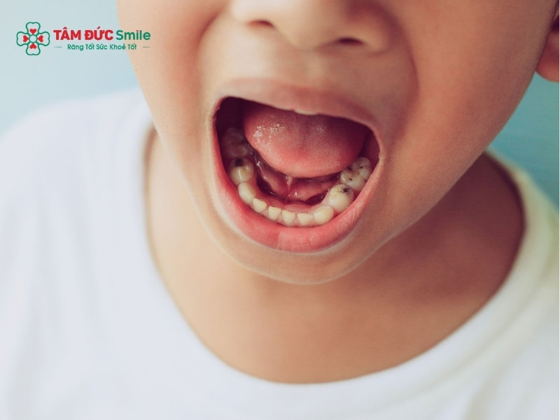Cách chữa sâu răng cho trẻ 2 tuổi an toàn, không đau, hiệu quả cao