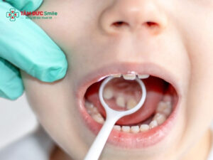 Chữa tủy răng và lưu ý sau khi chữa tủy răng cho trẻ