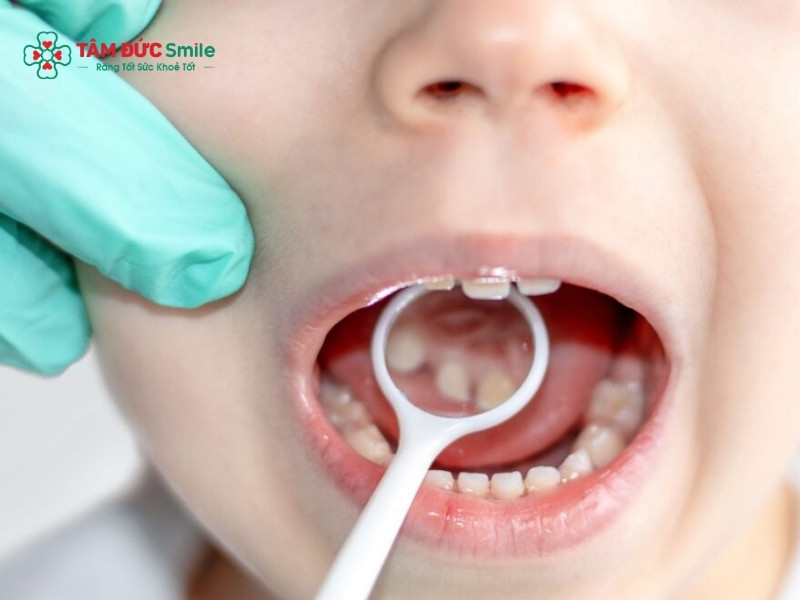 Chữa tủy răng và lưu ý sau khi chữa tủy răng cho trẻ