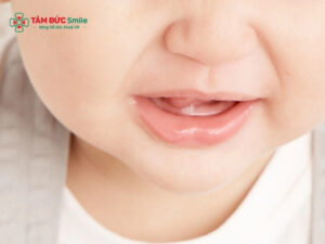Trẻ mọc răng lần đầu: Dấu hiệu nhận biết sớm và cách chăm sóc