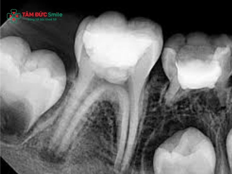 Điều trị tủy răng sữa an toàn, giảm đau, bảo tồn răng cho bé