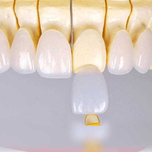dv-dan-su-veneer