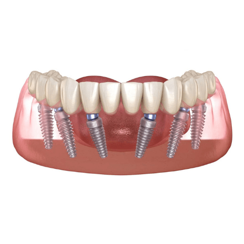 dv-implant-toan-ham