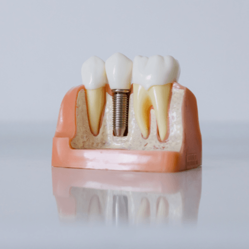 dv-trong-rang-implant