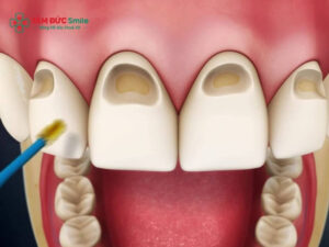 Hoại tử tủy răng: dấu hiệu, nguyên nhân và cách điều trị nội nha hiệu quả