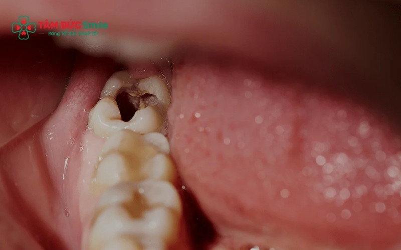 Phương pháp dùng lá chỉ giúp giảm triệu chứng tạm thời, không thể điều trị dứt điểm sâu răng