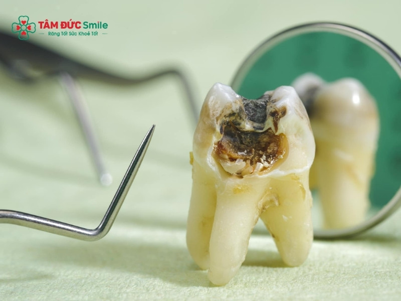 Lá gì chữa sâu răng hiệu quả? Mẹo giảm đau tại nhà nên biết