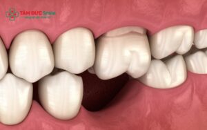 Mất chân răng có sao không? Nguyên nhân, hậu quả và cách phục hình hiệu quả